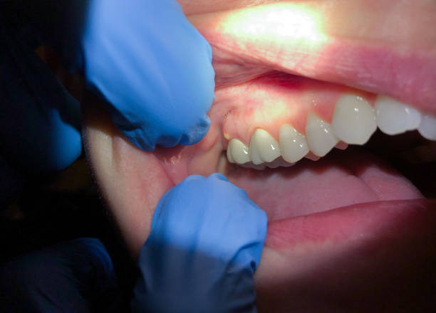 Best Emergency Dentist for Knocked-Out Tooth in Eagle Lake, FL