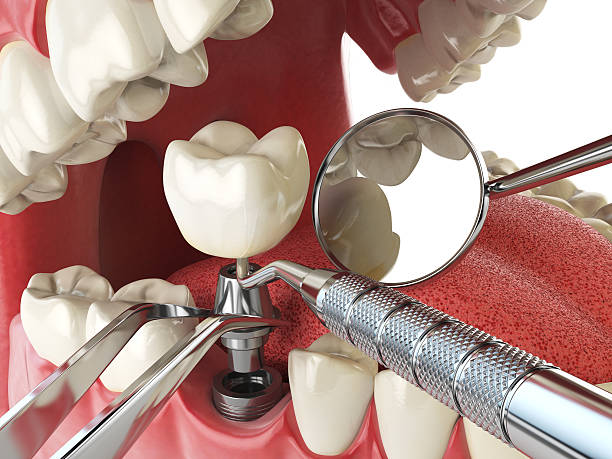 Best Emergency Dental Extractions in Eagle Lake, FL